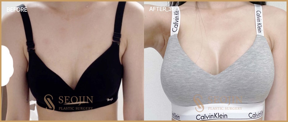 비대칭가슴수술 짝가슴이라서 고민이라면 관련 이미지 3