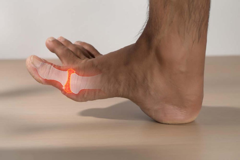 What Does Gout Mean? Toe Pain Symptoms and Foods Good for Gout image 4