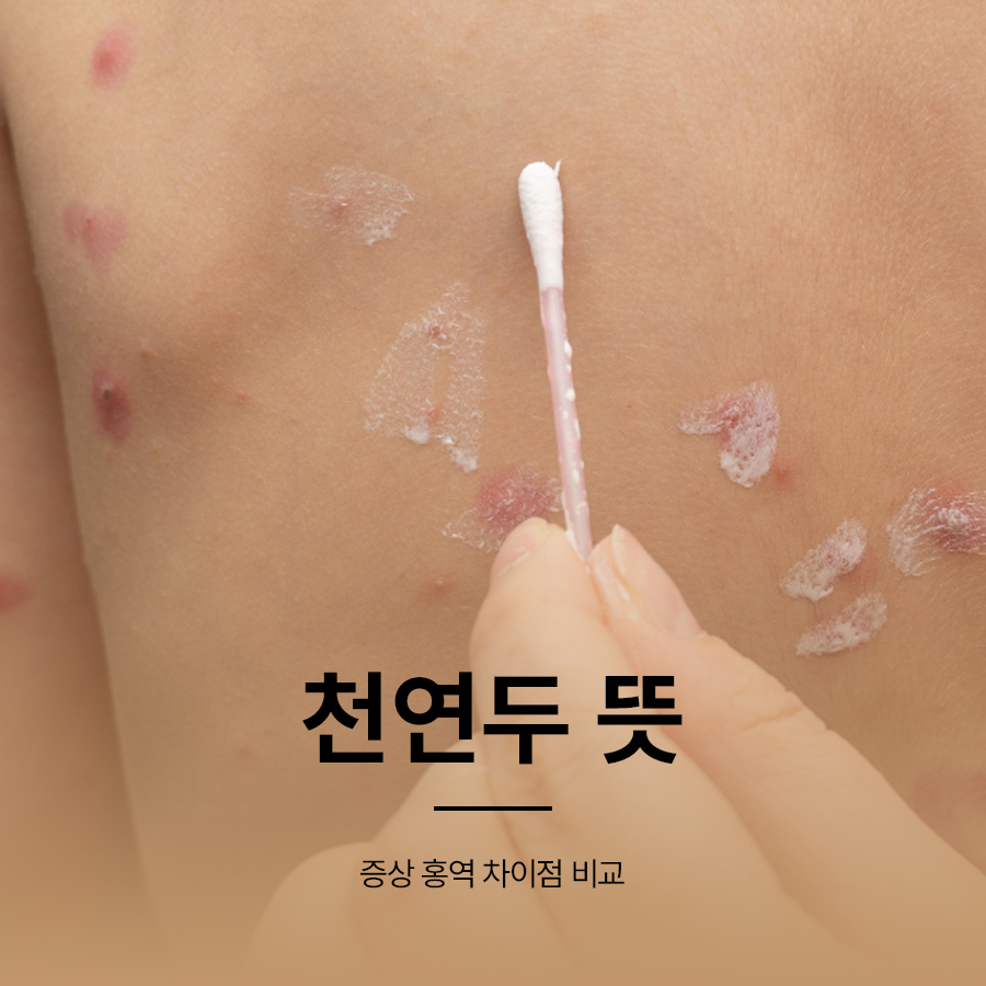 천연두 뜻 증상 홍역 차이점 비교 관련 이미지 1