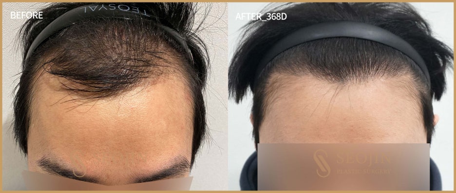 신사 모발이식 생착률을 높이기 위한 노력으로 관련 이미지 2