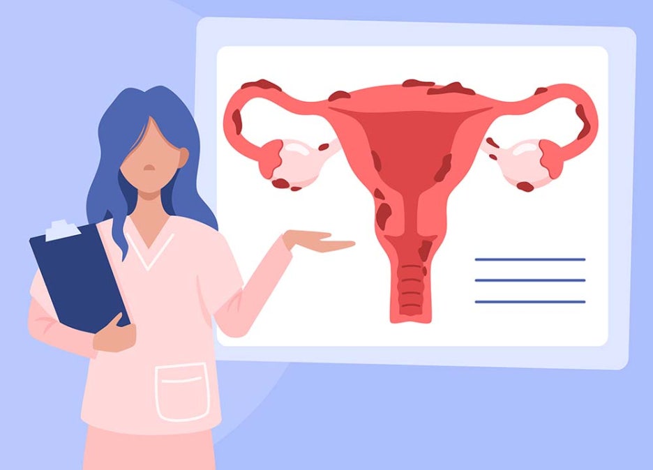 자궁내막증 원인 증상 용종이 보인다면? 관련 이미지 3