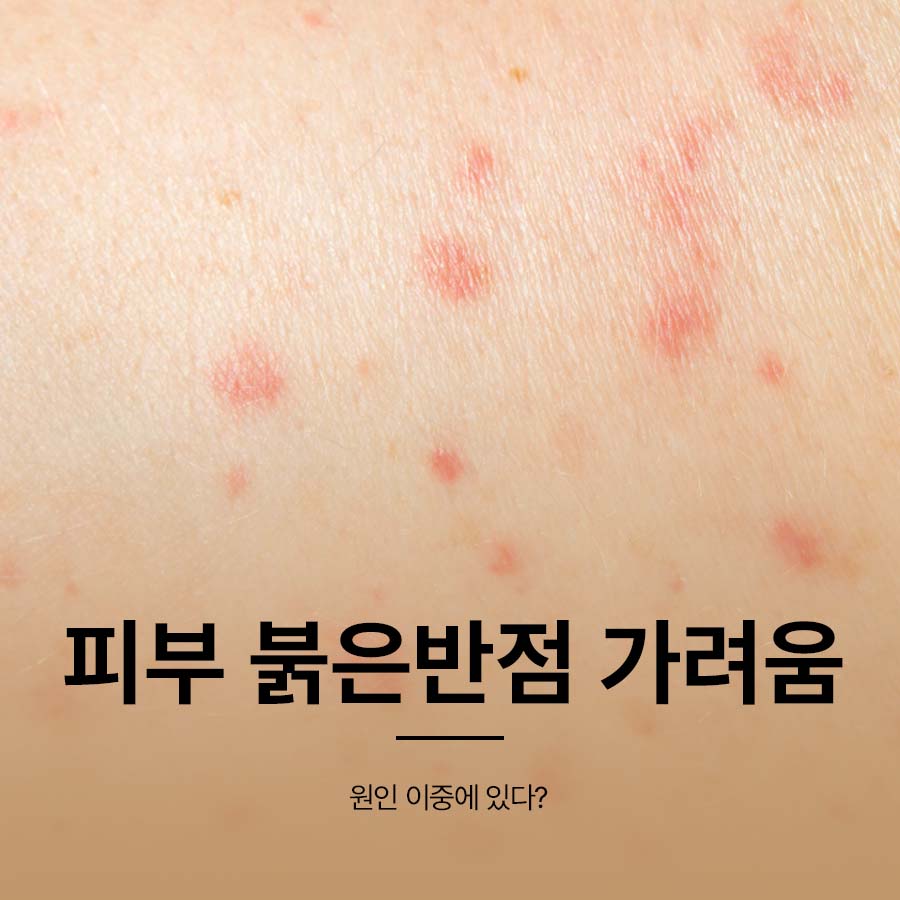 피부 붉은반점 가려움 원인 이중에 있다? 관련 이미지 1