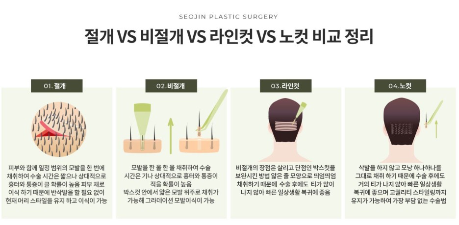 탈모 모발이식 탈모 유형 정리 관련 이미지 4