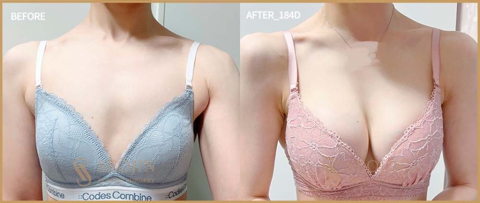 비대칭가슴수술 짝가슴이라서 고민이라면 관련 이미지 4