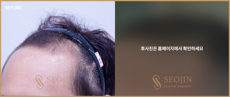 비절개모발이식수술방법 절개방법과 차이 관련 이미지 2