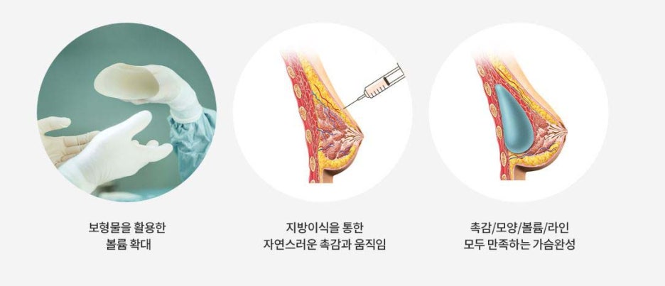 신사압구정 가슴성형 자연스러운 가슴 디자인으로 관련 이미지 3