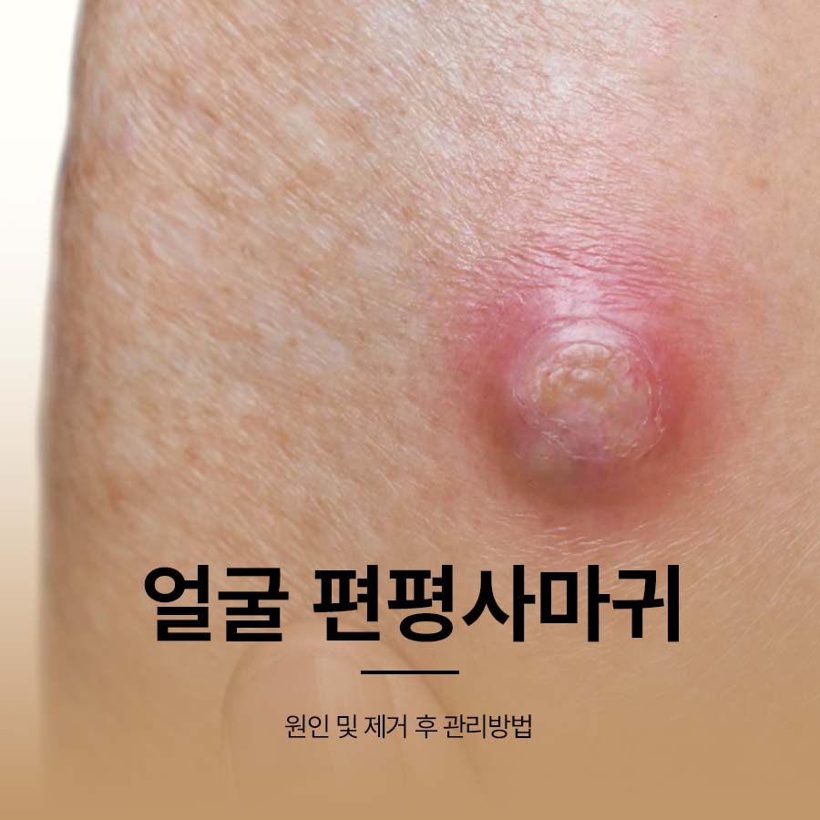 얼굴 편평사마귀 원인 및 제거 후 관리방법 관련 이미지 1