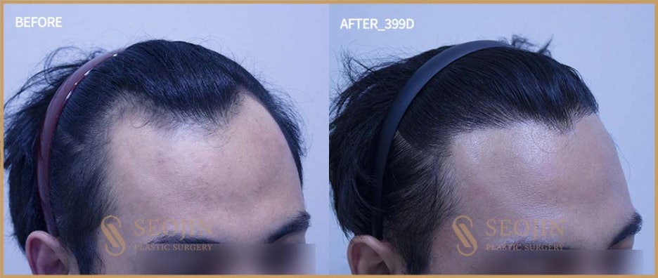 헤어라인모발이식 잘하는곳 내게 딱 맞는 비율로 관련 이미지 2