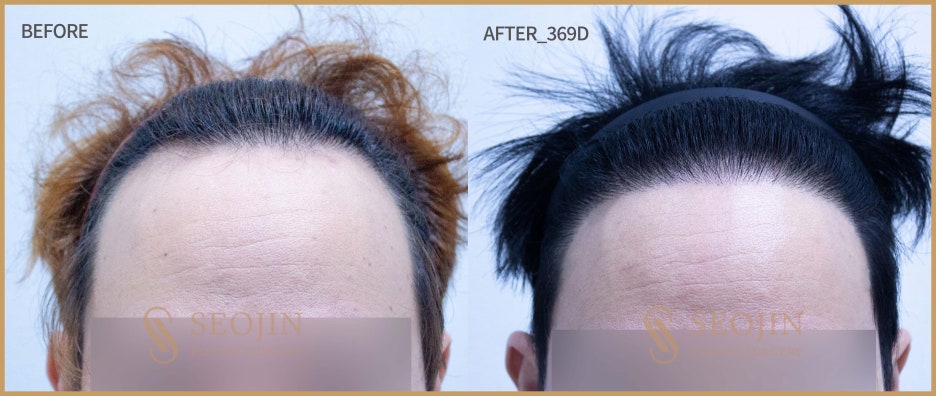 비절개 모발이식 무삭발 노컷으로 자연스러운 모습 관련 이미지 2