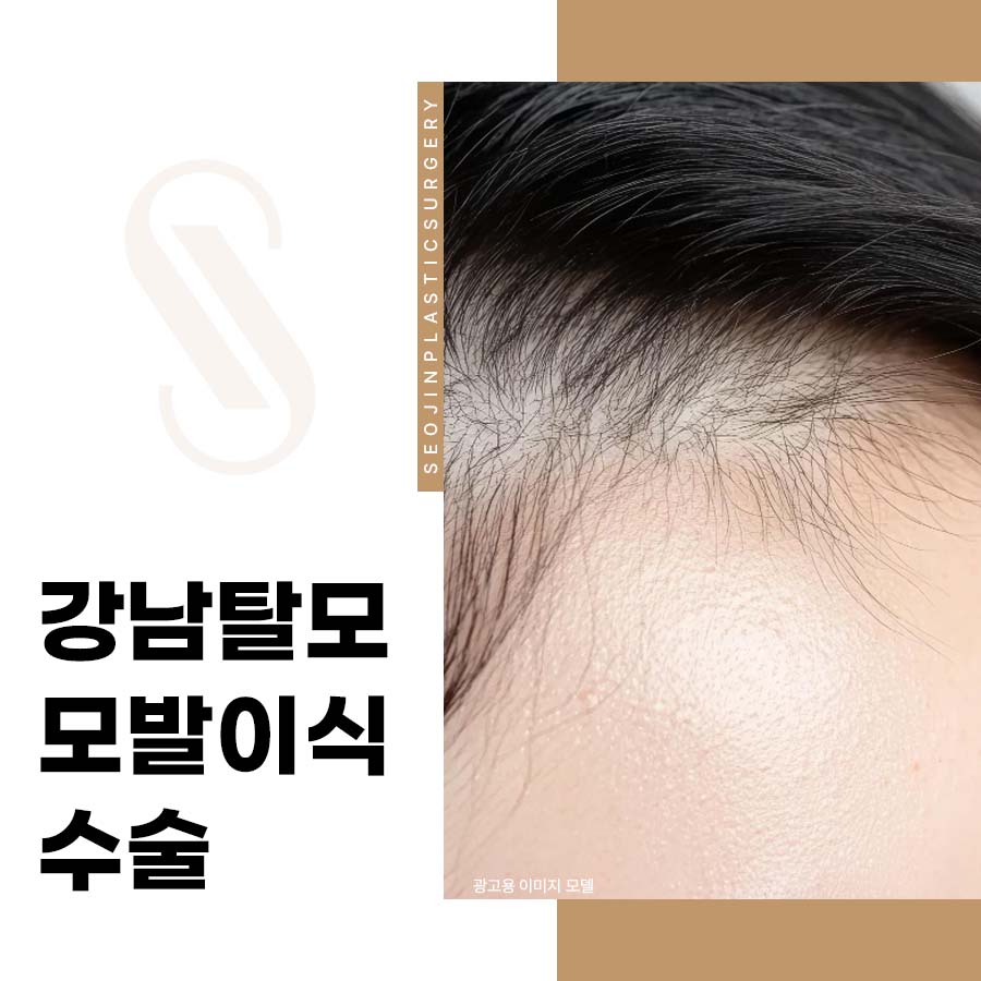Gangnam Hair Loss Hair Transplant Surgery: Different Points for Men and Women image 1