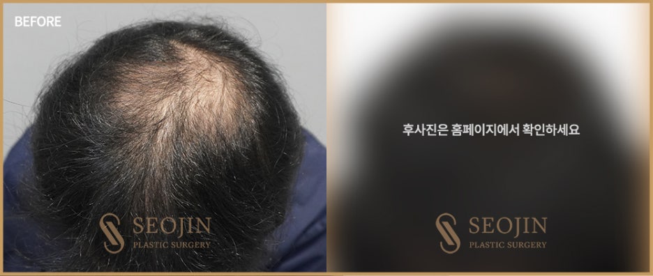 비절개모발이식수술방법 절개방법과 차이 관련 이미지 3