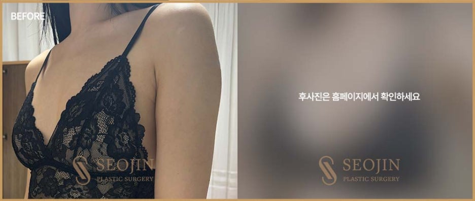 서진성형외과 처진가슴 원인에 대해 알아봐요 관련 이미지 6