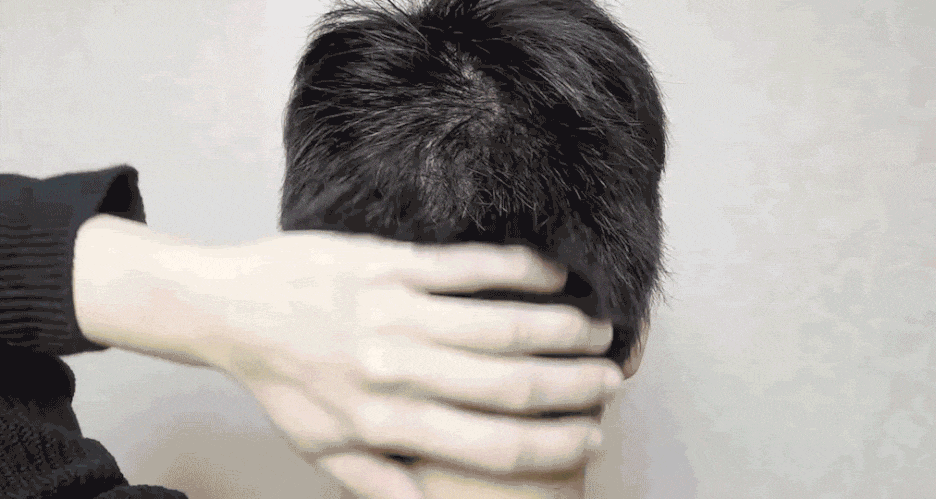 탈모 모발이식 탈모 유형 정리 관련 이미지 5