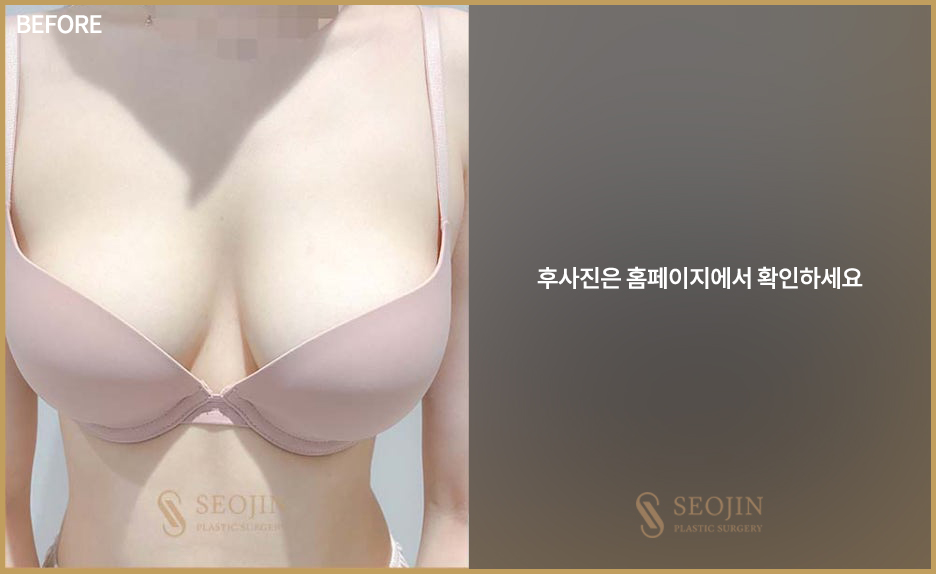 서진성형외과 처진가슴 원인에 대해 알아봐요 관련 이미지 2