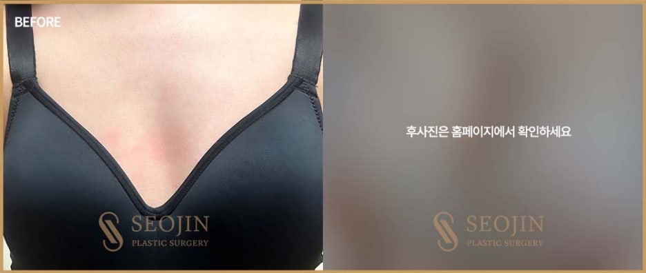 Learn About Breast Implant Types for Breast Surgery in Apgujeong image 2