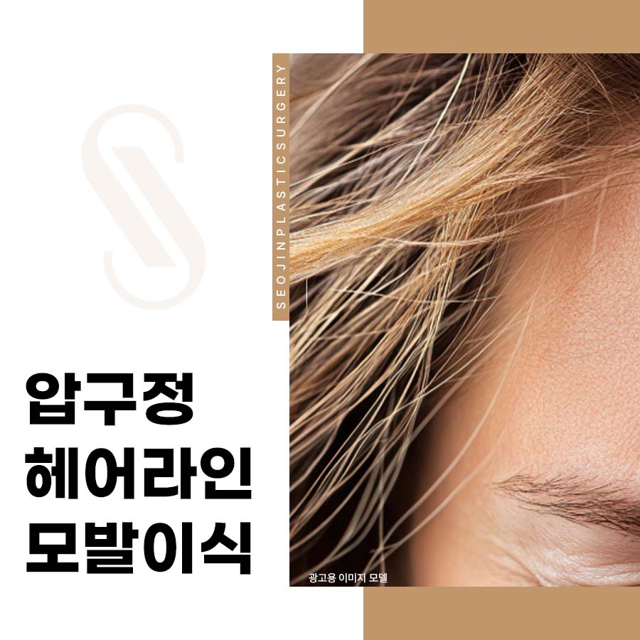 Apgujeong Hairline Hair Transplant: Is the Forehead the Cause of a Face Looking Bigger? image 1