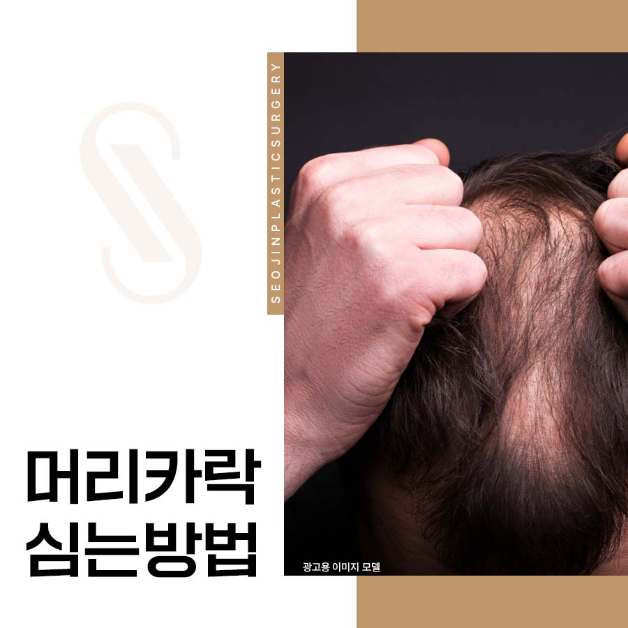 What Is the Right Hair Transplant Method for Me? image 1