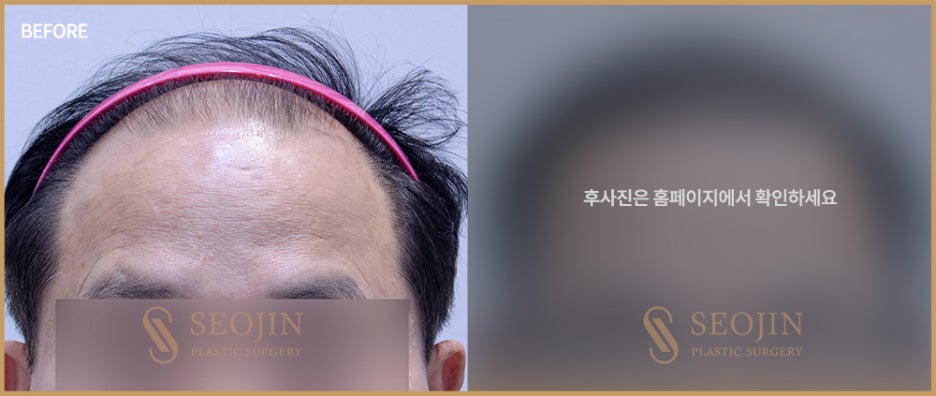 신사역 모발이식수술 탈모인을 위한 정보 관련 이미지 2