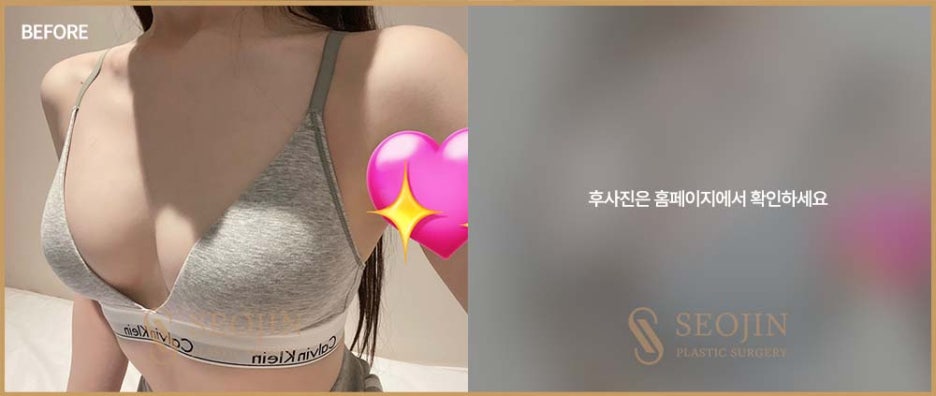 서진성형외과 처진가슴 원인에 대해 알아봐요 관련 이미지 4