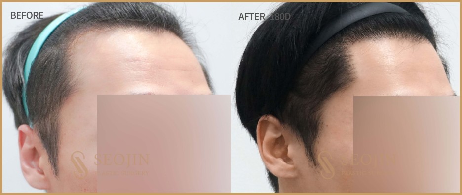 대량모발이식방법 티나지 않는 자연스러움 관련 이미지 3