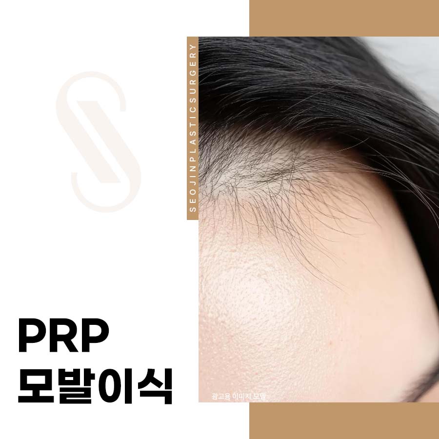 Seo Jin Plastic Surgery: The Relationship Between PRP Hair Transplantation and Graft Survival Rate image 1