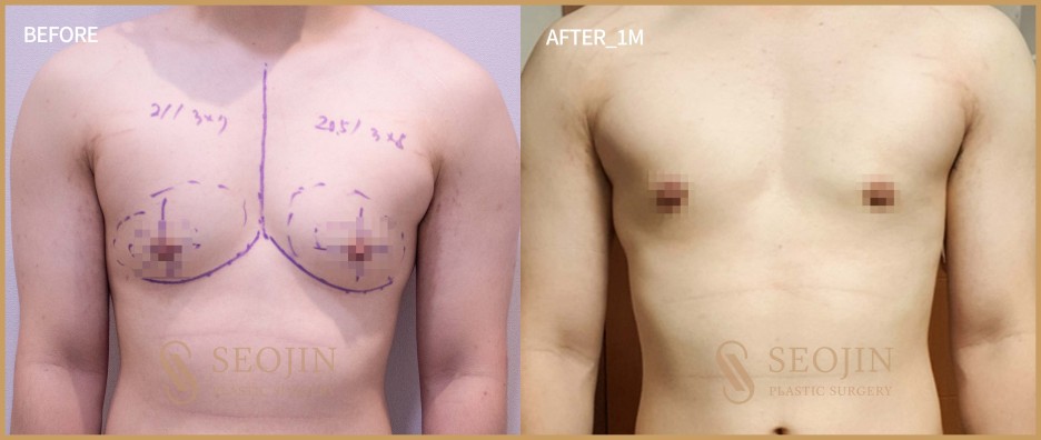 남자 가슴수술 여성형유방증 치료방법 관련 이미지 5