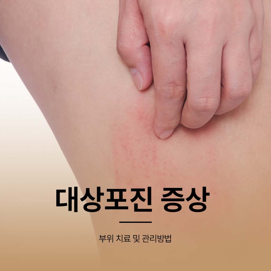 대상포진 증상 부위 치료 및 관리방법 관련 이미지 1