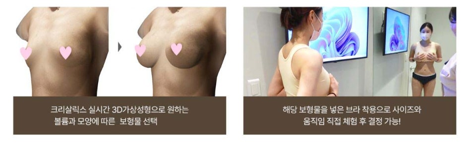 비대칭가슴수술 짝가슴이라서 고민이라면 관련 이미지 8