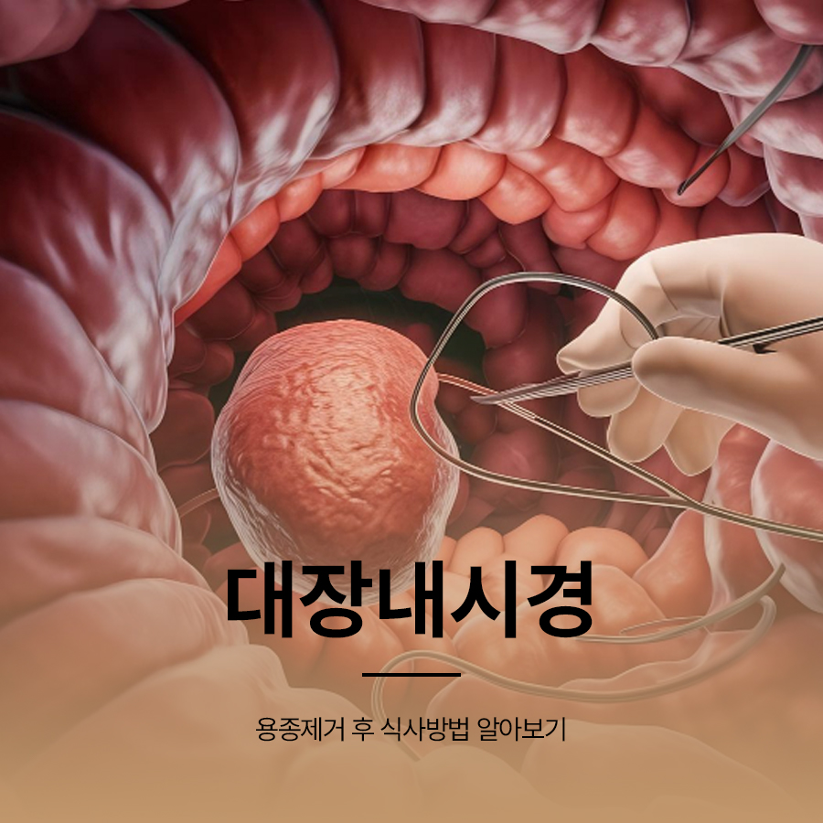 대장내시경 용종제거 후 식사방법 알아보기 관련 이미지 1