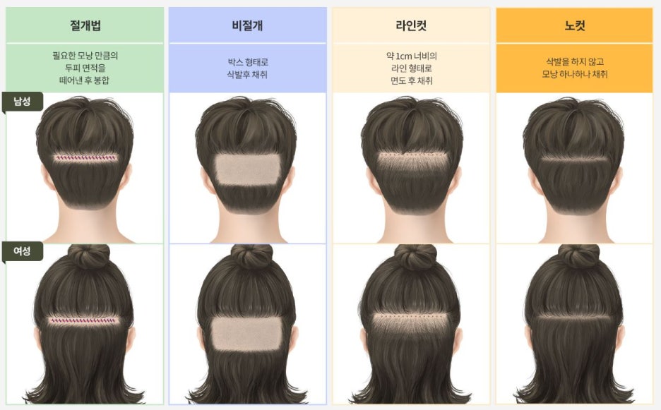 Apgujeong Seojin Plastic Surgery Hair Transplantation: Q&A You Must Know Before a Non-Incisional Procedure image 3