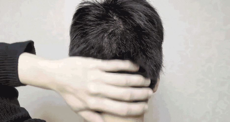 비절개 모발이식 무삭발 노컷으로 자연스러운 모습 관련 이미지 3