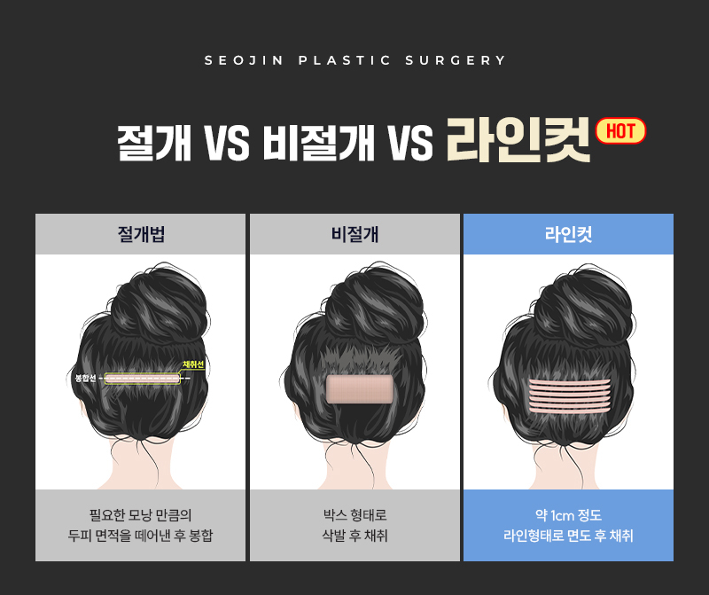 모발이식 라인컷 수술 후에도 자연스러운 일상 관련 이미지 6
