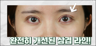 선릉역성형외과 눈재수술 어떤 기준으로 살펴보시나요? 관련 이미지 7