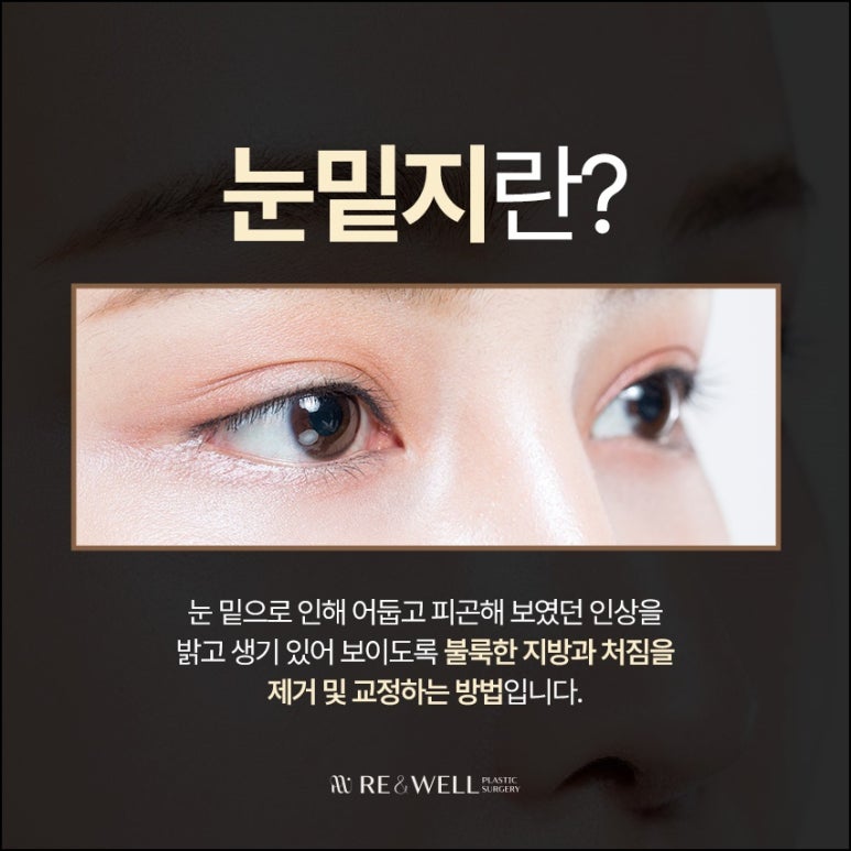 강남눈밑지성형외과 전반적인 상태 확인해야 관련 이미지 3