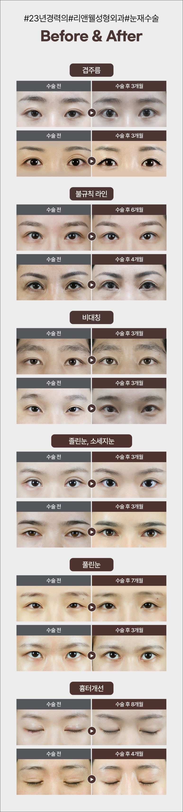선릉역 성형외과 눈재수술을 알아보신다면 관련 이미지 6
