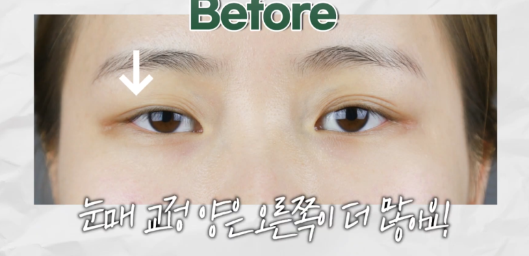 역삼역성형외과, 눈뜨기 힘든 졸린 눈 수술 전후 과정 살펴보기! 관련 이미지 4
