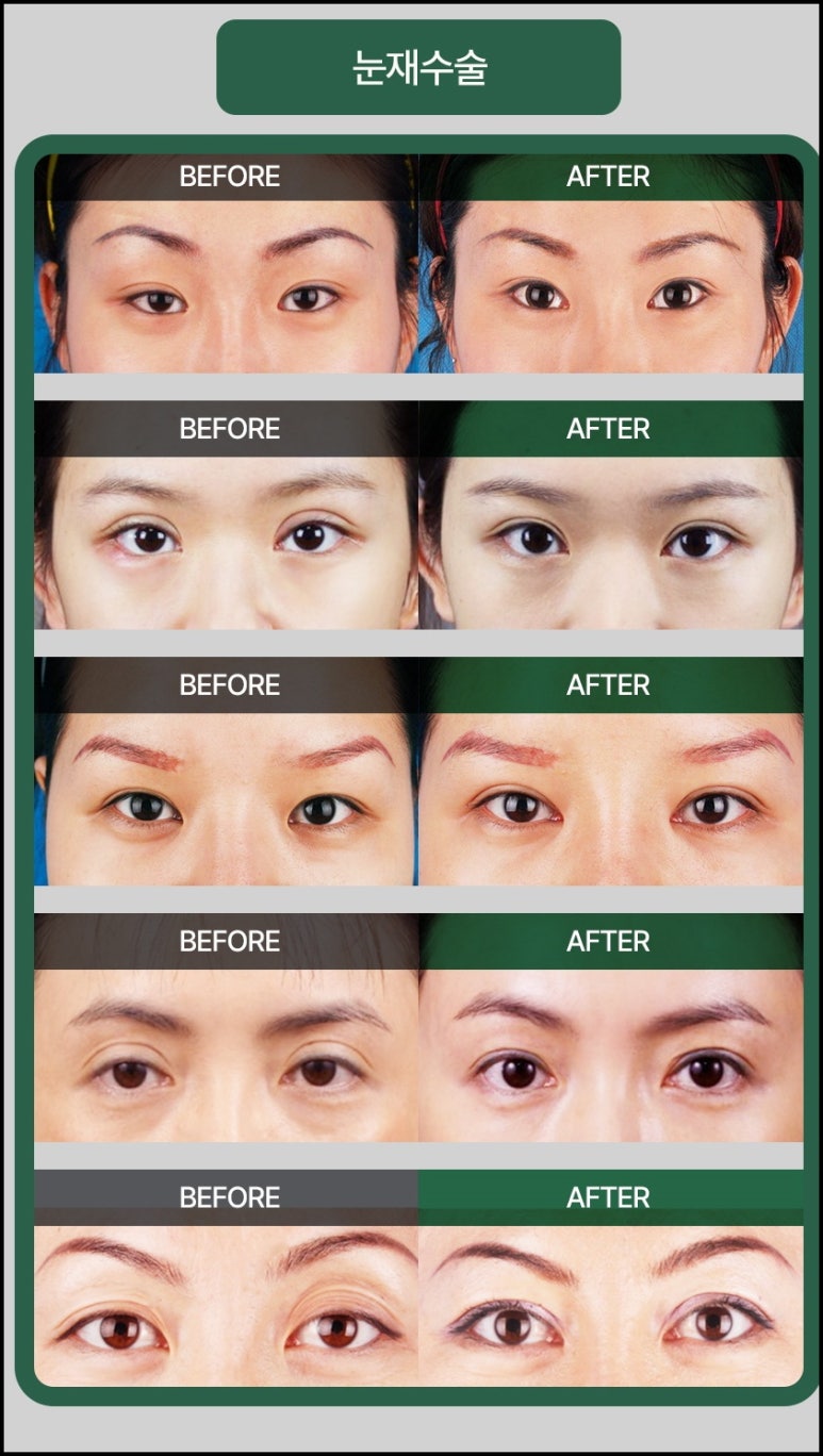 Gangnam-gu Plastic Surgery: Attention for Those Considering Eyelid Revision Surgery! image 7