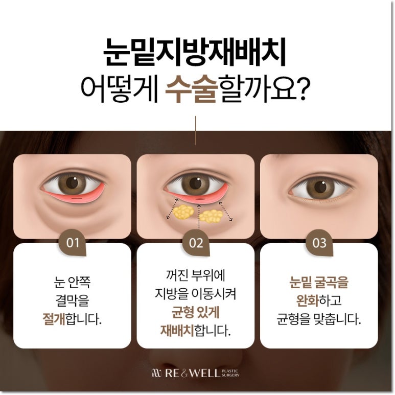 강남역삼동성형외과 눈 밑 변화의 원인부터 살펴봐요 관련 이미지 5