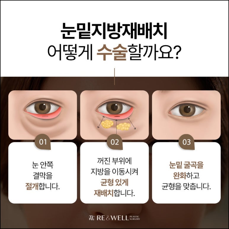 강남눈밑지성형외과 전반적인 상태 확인해야 관련 이미지 5