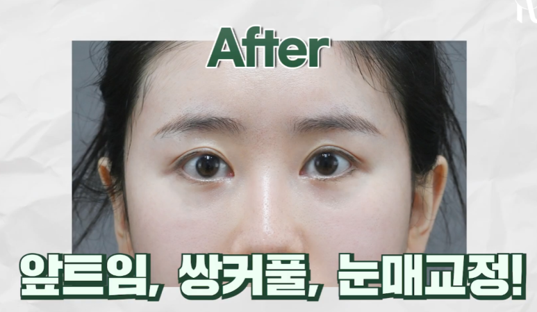 대치동성형외과 눈재수술을 통해 졸린 눈을 또렷한 눈으로 개선하는 과정 관련 이미지 4