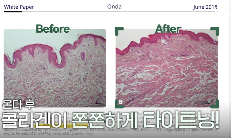 역삼리프팅, 온다리프팅 알아보시는 분들 주목! 관련 이미지 6
