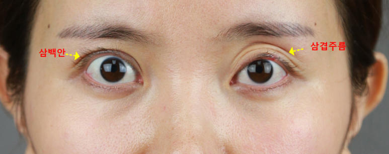 Gangnam Station Double Eyelid Revision Surgery: Let’s Look at Extreme Eye Cases (White-Eyed Appearance, Multiple Fold Creases) image 3