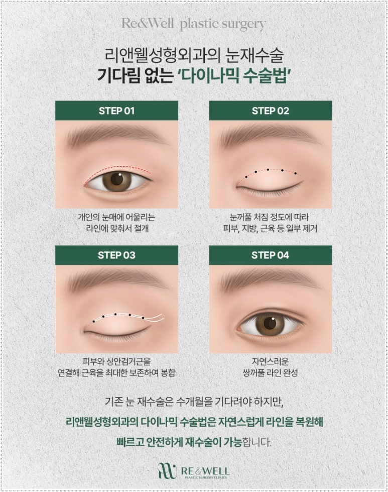 역삼동성형외과 다이나믹 수술법을 통한 눈재수술이란? 관련 이미지 4