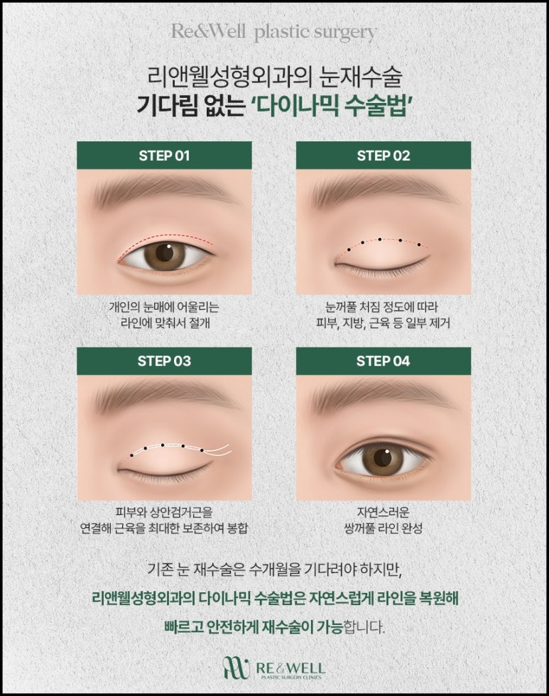 Gangnam-gu Plastic Surgery: Attention for Those Considering Eyelid Revision Surgery! image 5