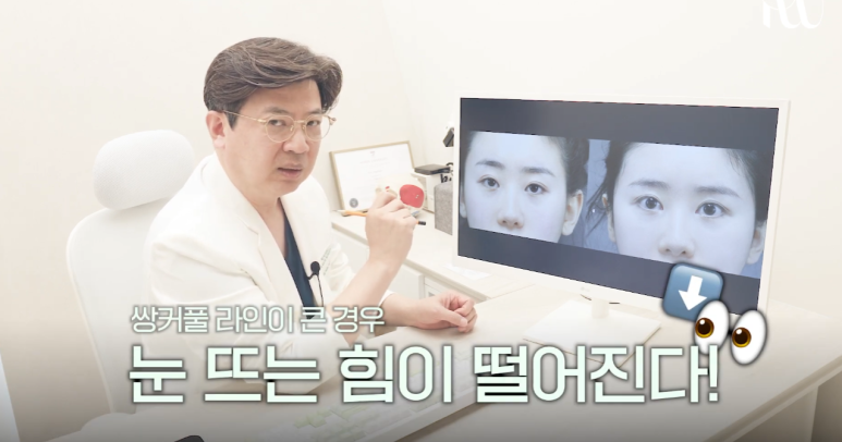 대치동성형외과 눈재수술을 통해 졸린 눈을 또렷한 눈으로 개선하는 과정 관련 이미지 8