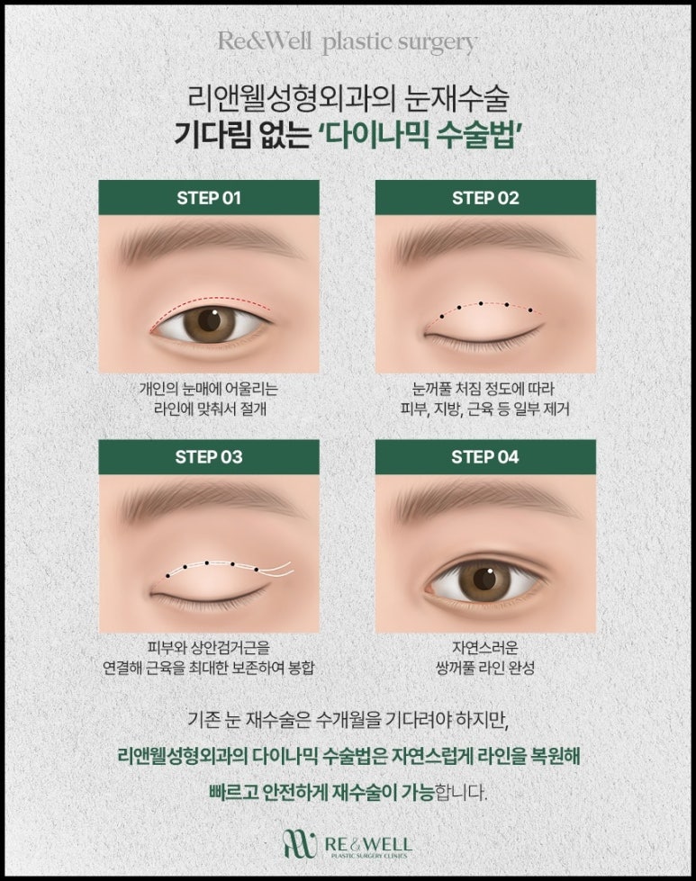 선릉역성형외과 눈재수술 어떤 기준으로 살펴보시나요? 관련 이미지 3
