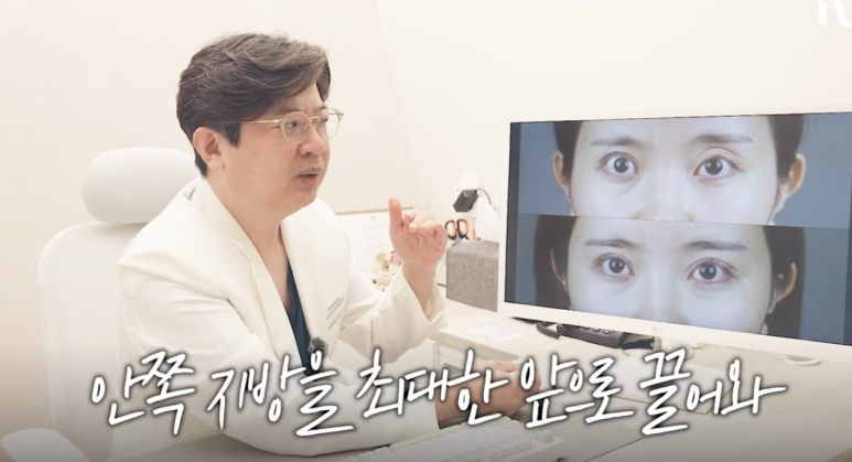 Gangnam Station Double Eyelid Revision Surgery: Let’s Look at Extreme Eye Cases (White-Eyed Appearance, Multiple Fold Creases) image 5