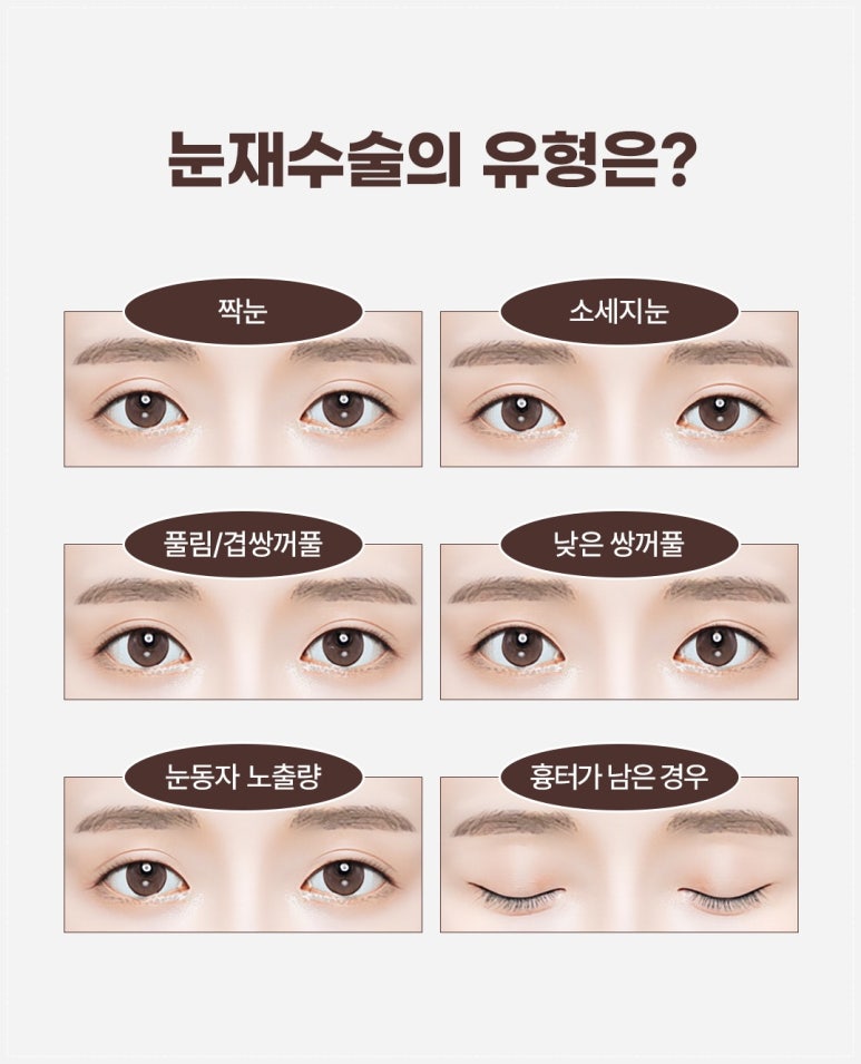 리앤웰성형외과 눈재수술을 알아보신다면 관련 이미지 3