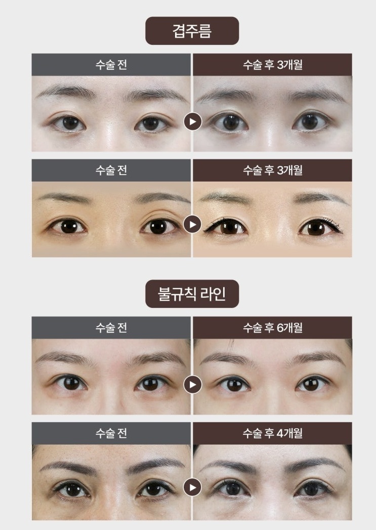 역삼동성형외과 눈재수술과 눈매교정 재수술, 함께 고려해야 하는 이유 관련 이미지 3