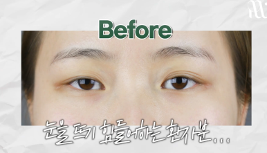 역삼역성형외과, 눈뜨기 힘든 졸린 눈 수술 전후 과정 살펴보기! 관련 이미지 2